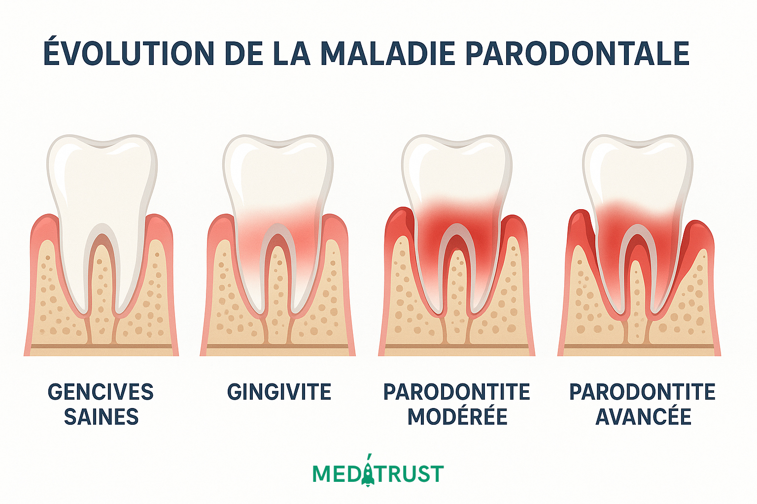 Évolution parodontite